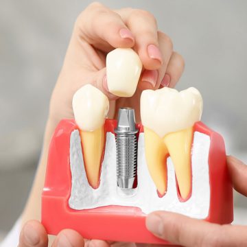 Why-Should-You-Choose-Dental-Implants-To-Replace-Teeth